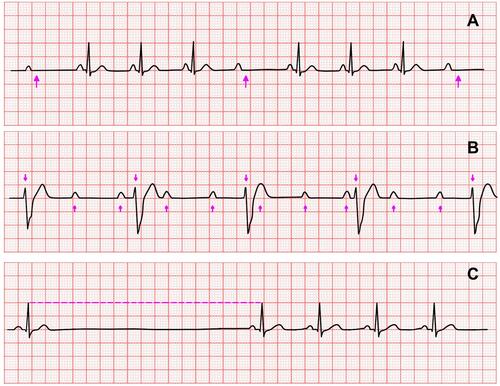 Figure 1 (A) Mobitz type 2 AV Block. There is intermittent non-conducted P waves without progressive prolongation of the PR interval. (pink arrow: p wave not followed by a QRS complex). (B) Third degree AV Block. ECG demonstrates complete AV dissociation, with independent atrial and ventricular rates (arrows pointing up: atrial activity; arrows pointing down: ventricular activity). (C) Sinus pause.