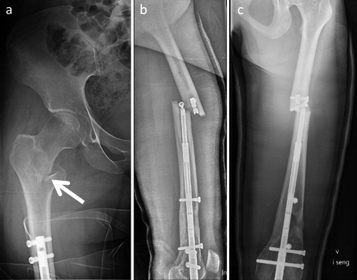 Figure 5 A 24-year-old woman who was lengthened 30 mm for idiopathic LLD with a retrograde lengthening nail. After consolidation of the regenerate she fell from a bicycle, sustaining a pertrochanteric femoral fracture (a). A 16-year-old girl with CFD, who underwent 40 mm of lengthening and correction of a valgus deformity with a retrograde lengthening nail. After consolidation of the regenerate she fell 2 m in a waterfall, sustaining a femoral fracture and breakage of the nail at the level of a locking bolt (b).