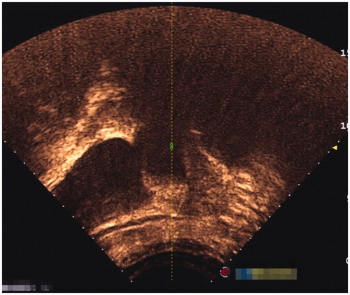 Figure 6. Contrast enhanced ultrasound showed no perfusion in the pregnancy tissue immediately after the HIFU treatment.