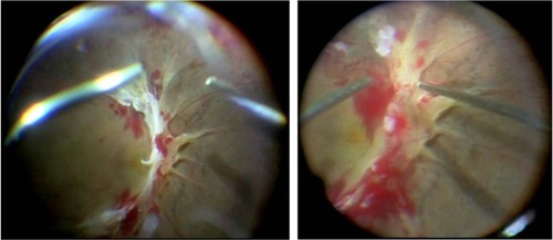 Figure 4 Fundus view through the contact lens with a 128-diopter objective lens (left) and with a 60-diopter objective lens (right) in a case of proliferative diabetic retinopathy.