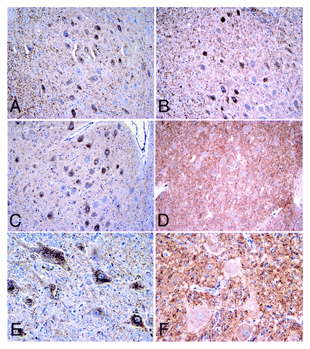 Figure 3. Epitope mapping results for the 87V infections in the dorsal motor nucleus of the vagus nerve of sheep. Note that Suffolk ARQ/ARQ sheep displayed intraneuronal immunolabelling with C-terminal antibodies such as Bar224 (A) and N-terminal antibodies such as P4 (B). Instead, Cheviot VRQ/VRQ (C, D) and ARQ/ARQ (E, F) sheep displayed the intraneuronal type with Bar224 (C, E) but not with P4 (D, F), a feature that is characteristic of strains like BSE and CH1641 when experimentally passaged in sheep. Immunohistochemistry for PrPd using Bar224 or P4 antibodies. Magnifications: x10 (A-D), x20 (E, F).