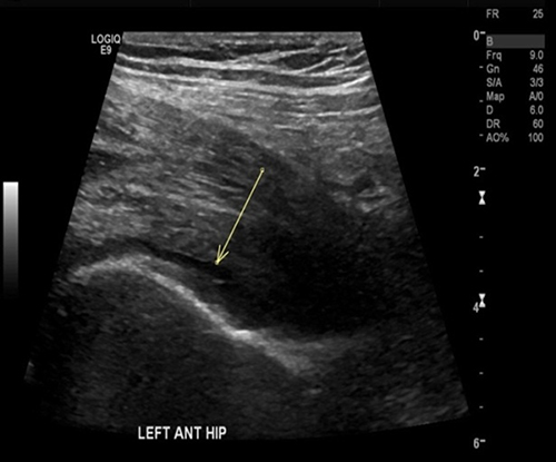 Figure 1 Left Hip ultrasound. Small left anterior Hip joint effusion of unknown aetiology.