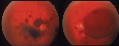 Figure 1 Fundus photograph of OD (left) and LE (right) showing subhyaloid, preretinal and retinal hemorrhages 1 week after the spinal surgery.