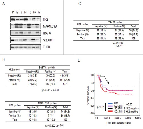 Figure 6. HK2 is correlated with SQSTM1 in clinical samples. (A) Immunoblot analysis of HK2, SQSTM1, MAP1LC3B and TRAF6 expression in tumors from 7 patients. (B) Correlation study of HK2, SQSTM1, and MAP1LC3B expression in the liver cancer TMA consisting of 129 samples. (C) Correlation study of HK2 and TRAF6 expression in the liver cancer TMA. (D) Kaplan-Meier plots of the overall survival of patients, stratified by expression of HK2 and SQSTM1. The data were obtained from the Sun Yat-sen University Cancer Center liver cancer dataset.