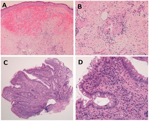 Figure 2. Histopathological findings of skin and ileal pouch. (A) Skin biopsies showed superficial and deep perivascular dermatitis without epidermal changes. (B) There were hemorrhage and chronic inflammation with giant cells and fibrosis in the epidermis, but there were no findings of vasculitis, such as vessel wall neutrophilic infiltration. (C) Histological findings of pouch mucosa showed total villous atrophy. (D) Moderate inflammatory cell infiltration and cryptitis.