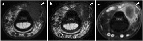 Figure 1. Preoperative magnetic resonance imaging. a T1WI; A well-defined mass, 1 cm in diameter, showing iso signal intensity. b T2WI; A mass showing low signal intensity with partial internal high signal intensity. c Fat-suppressed T1WI-gadlinium showing enhancement on the margin of the mass.