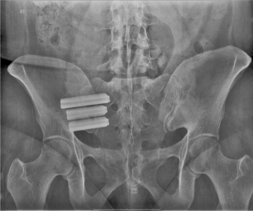 Figure 1 Outlet view of pelvis with titanium implants.