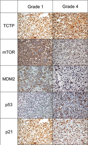 Figure 1 Immunoexpression for the five proteins TCTP, mTOR, MDM2, p53 and p21. Left column shows astrocytomas grade 1 and right column shows astrocytomas grade 4 (IHC, 200x).