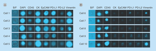 Figure 4.  Representative images from the microfluidic chipcytometric detection and characterization of spiked tumor cells.(A) H1975 cells detected in the spiked samples. The staining profile allows us to distinguish these cells from the white blood cells. (B) Representative images of white blood cell contaminants present after enrichment by ClearCell FX® system.