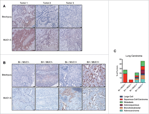 Figure 3. Association of brachyury and MUC1 expression in patient tumor samples. (A) Immunohistochemistry images of colon carcinoma liver metastasis tumor samples stained for brachyury or MUC1-C, respectively. (B) Representative immunohistochemistry images of lung carcinoma tumor samples stained for brachyury or MUC1-C, respectively, for each of the 4 expression categories as described in the text. Images were acquired at 100X. (C) Quantification of the lung carcinoma tumor samples in each of the four expression categories by histological subtype.