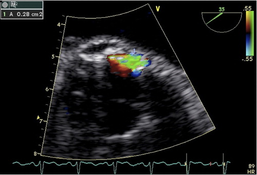 Figure 1. Colour-Doppler image from a transoesophageal echocardiography examination. The area of the paravalvular leak is traced (A 0.28 cm2).
