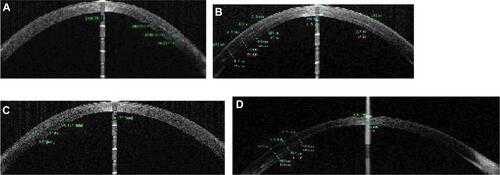 Figure S6 Visante optical coherence tomography cut of study cases (A–D) through the cornea 12 months after graft implantation.