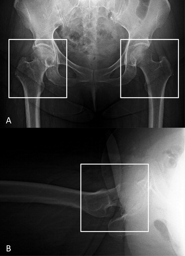 Figure 1. Image preprocessing for the convolutional neural network model training and validation. We cropped images to a minimum region containing the femoral head and the greater and lesser trochanters in both the AP (A) and lateral (B) hip radiographs. On the AP radiographs, the fractured hip (left white box) was cropped and the side contralateral from the fractured hip (right white box) was cropped as the non-fractured hip. AP = anteroposterior.