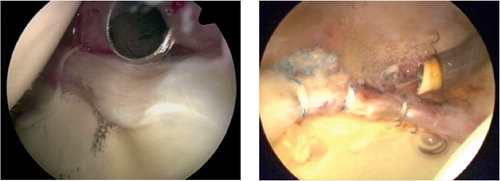 Figure 5. Arthroscopic pictures illustrating (a) a detached labrum with wave sign and synovitis, and (b) a labrum re-attached to the acetabular rim with 3 suture anchors. (The images were kindly provided by the Department of Sports Traumatology, Aarhus University Hospital, Denmark).
