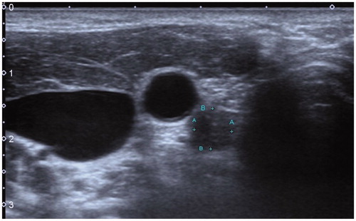 Figure 7. The patient was last reexamined in January 2020. Ultrasound images showed that the size of the ablated lymph nodes was significantly reduced. The size of lymph nodes was about 0.61cmx0.57 cm.