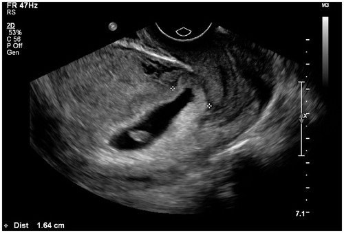 Figure 4. Thirty-six-year-old patient, G4P1, 50 days gestation, vaginal bleeding (+). Blood β-HCG 168,136 IU/ml. Ultrasound showed an elongated gestational sac with lower extremity implanted in the uterine lower segment (between calipers). There was no lacunar-like change of chorion membrane.