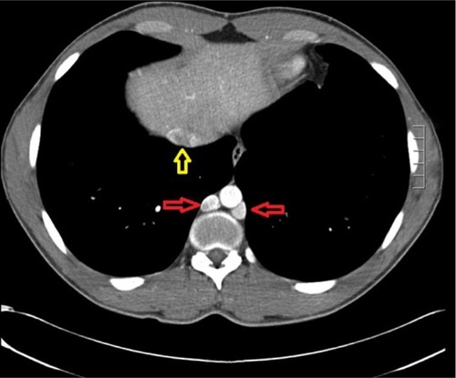 Figure 1 Chest CT with contrast. Azygos-hemiazygos (red arrows) and the hepatic portion of the IVC (yellow arrow).
