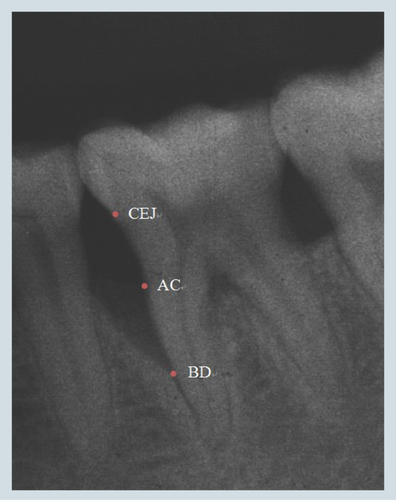 Figure 3.  Radiographic landmarks.AC: Alveolar crest; BD: Base of the defect; CEJ: Cemento–enamel junction.