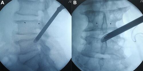 Figure 3 Positioning of the working cannula in fluoroscopic view ((A), sagittal; (B), anteroposterior).