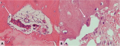 Figure 1. Different osteoclasts. A: Giant osteoclast, detached from the bone, in a resorption cavity close to the fracture line of an atypical femoral fracture. B: Normal osteoclast in a healthy individual with tibial stress fracture.