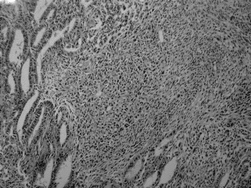 Figure 2.  Peritoneal Malignant mixed mullerian tumor characterized by admixture of epithelial (endometrioid type gland) [arrow] and non-epithelial (spindle cells) sarcomatous elements [arrowhead].