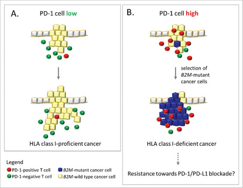 Figure 4. Influence of PDCD1 (PD-1)-positive T cell infiltration on immune evasion in MSI colorectal cancer. A (left panel): Low levels of PDCD1 (PD-1)-positive T cells within the tumor microenvironment likely reflects a condition of less stringent immune selection, which allows the outgrowth of HLA class I antigen-positive, B2M-wild type cancer cells. B (right panel): Outgrowth of B2M-mutant cancer cells (blue), which lack HLA class I antigen expression, predominantly occurs in an activated local immune environment characterized by PDCD1 (PD-1)-positive T cell (red) infiltration. This observation supports the immunoediting concept in MSI colorectal cancers. If B2M mutations interfere with anti-PDCD1 (PD-1)/CD274 (PD-L1) therapy success, MSI cancers with high PDCD1 (PD-1)-positive T cell infiltration (right panel) may be resistant towards anti-PDCD1 (PD-1) antibody therapy due to lack of HLA class I antigen expression.