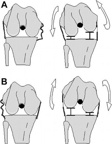 Figure 1.  A. After a medial release (already released in the drawing to the left), when a tensor is inserted in the knee the femur would theoretically exorotate as a result of the loosened medial ligament structure. B. After a lateral release (already released in the drawing to the left), when a tensor is inserted in the knee the femur would theoretically endorotate as a result of the loosened lateral ligament structure.