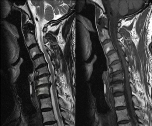 Figure 1 Global type cervical kyphosis with Modic-1 changes in C5–C6 and C6–C7.