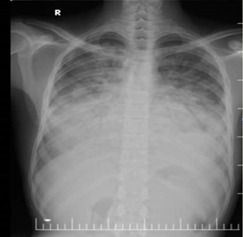 Figure 2 PA chest X-ray shows enlargement of cardiac shadow.