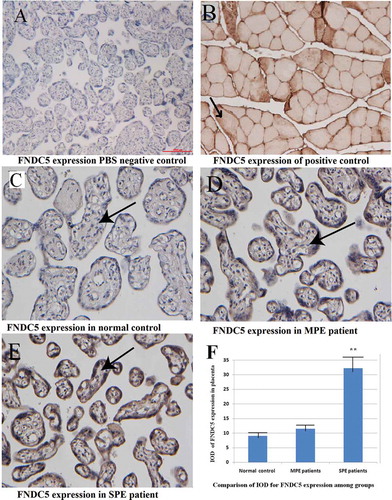 Figure 2. Expressions of irisin precursor (FNDC5) in placental tissue by Immunochemistry. Expressions of FNDC5 in SPE group were highly increased and were mainly located in the cytoplasm of placental trophoblastic cells and syncytiotrophoblast cells (brown deposits), A for PBS solution replace antibody as a negative control; B for a positive control (skeletal muscle tissues); C for normal pregnancy; D for MPE group and E for SPE group. There was higher integral optical density (IOD) of FNDC5 expression in placenta in SPE in comparison with normal control by semi-quantitative analysis, **P<0.01 Vs. Normal control （F）.