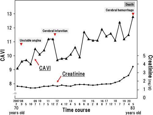 Figure 3 Increase in cardio-ankle vascular index (CAVI) over 13 years in an atherosclerosis patient with a high baseline CAVI. This patient showed a rapid rise in CAVI (to 11.5) a few months before cerebral infarction and a high rapid rise to 12.8 just prior to cerebral hemorrhage.