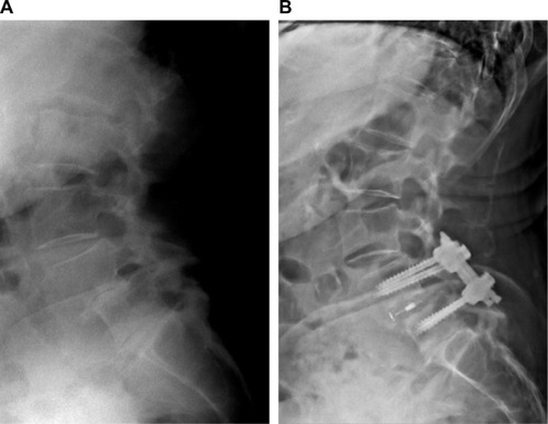 Figure 5 Radiographs showing preoperative grade I–II degenerative spondylolisthesis with total disc collapse at L4–5 (A) and stable construct with restoration of disc space 3 months after minimally invasive TLIF with Luna 3D® (Benvenue Medical Inc., Santa Clara, CA, USA) cage (B). At 3 months, the patient is doing well clinically and reported complete resolution of low back and lower extremity pain.