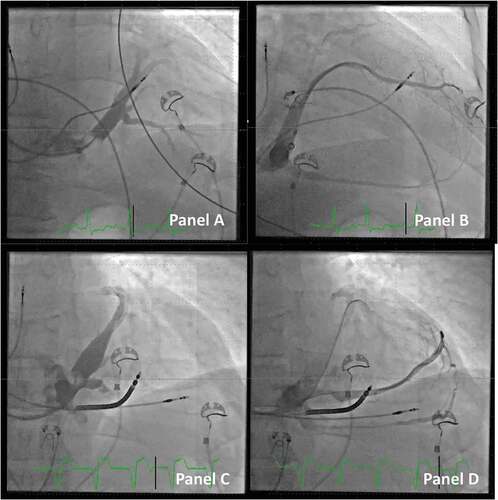 Figure 4. Defining the CS anatomy by direct venography. Panel A: Occlusive venogram in the main CS visualizing the distal part of the venous system (anterior-posterior projection).Panel B: the same patient as panel A. Selective direct venography of the chosen target vein displaying details of the vein including collaterals extending back to the middle cardiac vein (right anterior oblique projection).Panel C: Another patient with the occlusive venogram in the main CS. The venogram only shows the distal part of the venous system and is partially blocking the take-off of a large proximal vein.Panel D: The same patient as panel C. The proximal vein is targeted with the vein selector and guidewires, and a direct venography clearly delineates the outline of the vein including multiple collaterals. Note that the outer coronary sinus guide is kept in place in the CS despite the proximal position by extending the J-shaped support guidewire into the main CS toward the anterior part.