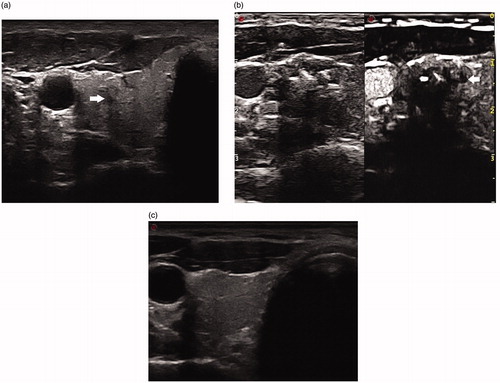 Figure 2. (a) Before LA, transverse ultrasound image revealed a hypoechoic nodule (arrow) with an ill-defined border 56.2 mm3 in volume, which was confirmed as a papillary thyroid microcarcinoma. (b) After LA, the necrotic area (arrow) 684.6 mm3 in volume was significantly larger than the target tumor on CEUS. (c) Ultrasound examination showed that the ablated lesion completely disappeared at the last follow up.