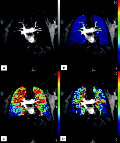 Figure 8 Parameter maps of quantitative analysis of MR perfusion acquired during inspiratory breath-hold: original image of time-resolved MR perfusion (A) showing severe perfusion defects in the lower lobes and normal perfusion in the right upper lobe; mean concentration (B); pulmonary blood flow (C) and pulmonary blood volume (D).
