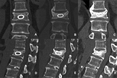 Figure 3 A typical case of vertebral height (L1) loss during the follow-up. (A) Coronal image at 1 day after operation. (B) Coronal image at 1 year after operation. (C) Coronal image at 3 years after operation. (D) Sagittal image at 1 day after operation. (E) Sagittal image at 1 year after operation. (F) Sagittal image at 3 years after operation.