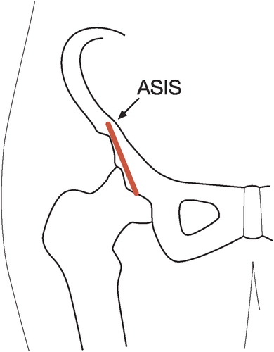 Figure 5. Incision of the new minimally invasive transsartorial approach (red line). The anterior superior iliac spine is marked ASIS.