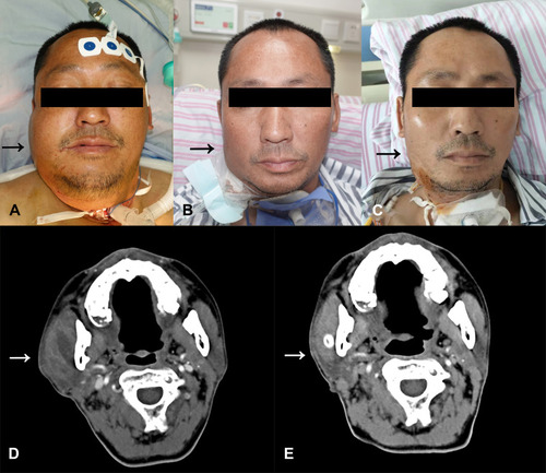 Figure 5 The swelling of the infected area was notably improved after the patient being treated with the MIVD device. (A) The preoperative picture of the patient. Asymmetry in the head and neck area was obvious (A, the black arrow). (B) The picture of the patient on the fifth day after the surgery. The swelling subsided effectively (B, the black arrow). (C) The picture of the patient on the seventh day after the surgery. The patient’s facial appearance returned to normal (C, the black arrow). (D) The preoperative contrast-enhanced CT scan showed swelling of the infected area. Abscess cavities were found (D, the white arrow) (E) Contrast-enhanced CT scan on the fifth day after the surgery. The swelling markedly subsided and abscess cavities were controlled (E, the white arrow).