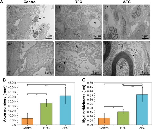 Figure 5 Transmission electron micrographs of the middle lesion site. (A) (a1–a2) Axons with loose myelin sheaths and abundant collagen regenerated in the area of lesion site in the control group; compared to the control group, a great deal of myelinated axons with relatively compact myelin sheaths (Ax) are seen in the middle region of lesion site (c1–c2), and accompanying blood vessels (V) in the RFG group (b1–b2). The arrows show the axons. (B and C) The number and myelin thickness of axons in the middle lesion site are summarized and analyzed. Data are expressed as mean ± standard deviation. Statistical comparisons were performed using ANOVA, and *p < 0.05, **p < 0.01. Four individual rats per group were used for statistical analysis (n = 4), and five TEM images per rat were used for the axon counts and myelin thickness calculation.Abbreviations: AFG, aligned fibrin hydrogel; ANOVA, analysis of variance; RFG, random fibrin hydrogel; TEM, transmission electron microscopy.
