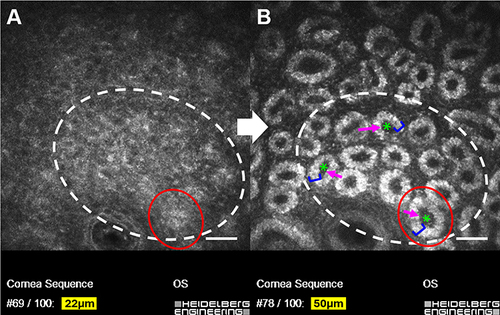 Figure 1 Image of rete ridges at the lid margin of an upper lid using in vivo confocal microscopy (IVCM). (A) Superficial epithelial cell aggregates which organize into orifice-associated rete ridge epithelial/basement membrane structures (OARREBS) with increased depth. (B) At a greater depth, each rete ridge has a bright outer epithelial cell layer (blue bracket), a dark center dermal component (green asterisk), and a junctional basement membrane that resides between these two (pink arrow).Citation11,Citation12 White dashed circle denotes the area of interest while red circle highlights a single rete ridge from the progression of epithelial cell aggregate (A) to complete rete ridge formation (B) as the depth increases. Scale bar, 50µm.