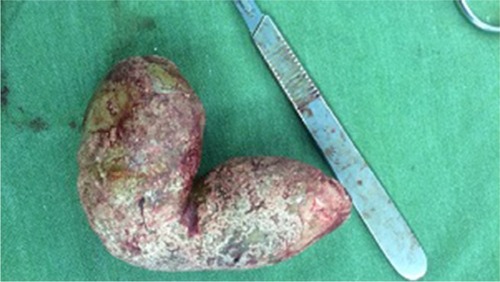Figure 2 Extracted giant ureteral stones measuring 14 cm in length and 106 g in weight in the left ureter.