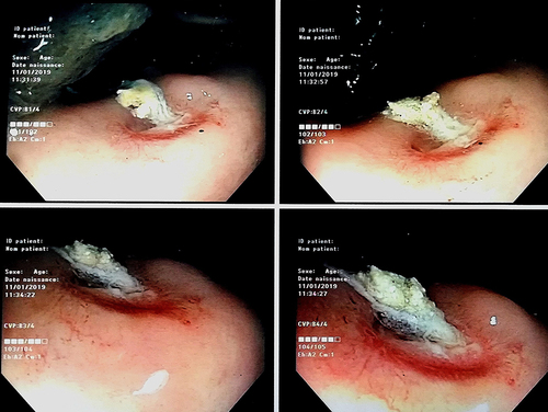 Figure 3 Recto-sigmoidoscopy of a 75-year-old man showing uncommon fistulous orifice with leakage on the anterior rectal wall.
