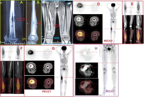 Figure 1 Representative imaging results from the patient with metastatic retinoblastoma to the bone in case 1 in Table 1. (A and B) CT scans showing significant bone destruction, soft tissue swelling, and intramedullary neoplasm. The red arrow showing obvious bone destruction. (C) Simultaneous magnetic resonance images showing serious bone destruction and soft tissue swelling. The red arrow showing obvious swelling of soft tissue around the diseased bone. (D–G) Positron emission tomography/CT scans showing visible thickening in the middle and distal shaft of the right femur, the soft tissue in the medullary cavity, discontinuous bone cortex, bite-like bone destruction with diffuse periosteal reaction, an uneven increase of radiation uptake, and soft tissue swelling around the lesion. Maximum standardized uptake value: 8.42. (H) Postoperative PET/CT.