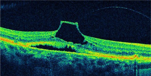 Figure 23 An incomplete posterior vitreous detachment with vitreomacular traction and tractional foveal detachment is observed on this optical coherence tomography image.