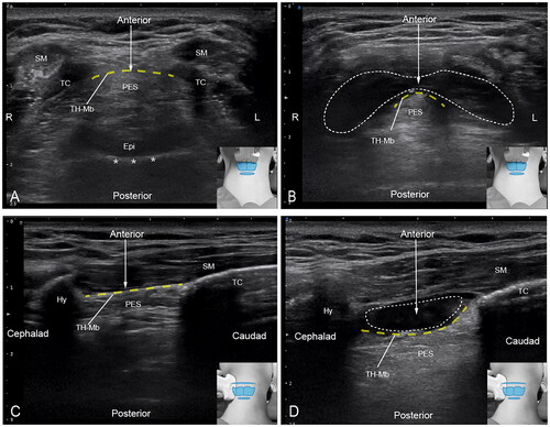 Figure 1. Transverse sonography of the modified ultrasound-guided anterior superior laryngeal nerve block (SLNB) (A,B), and parasagittal sonography of the traditional ultrasound-guided posterior SLNB (C,D). (A) midline transverse plane ultrasound image at the level of the thyroid notch. TH-Mb is identified at ultrasound as bounded anteriorly by the TC and posteriorly by the PES. (B) When performing SLNB via the modified anterior approach, lidocaine were injected targeting the space anterior to TH-Mb. Lidocaine were visualised to push the TH-Mb, and it diffused rapidly to lateral paraglottic space. (C) Right parasagittal ultrasound image when performing ultrasound-guided posterior SLNB. TH-Mb is a hyperechoic layer, marking the interface with the PES. (D) Lidocaine were injected targeting the space anterior to TH-Mb and were visualised to push the TH-Mb. Yellow dotted line: TH-Mb, white solid arrow: needle orientation, white dotted circled area: lidocaine. SM: strap muscles; TC: thyroid cartilage; Hy: hyoid bone; TH-Mb: thyrohyoid membrane; PES: pre-epiglottic space; epi: epiglottis.