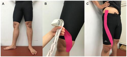 Figure 1 Illustration of the hip corrective taping using kinesio tape. The tape was placed outside the shorts only for demonstration. (A) The affected limb was positioned in maximal hip external rotation, slight abduction, and knee extension. (B) An I strip of kinesio tape was anchored at the medial tibial condyle and then applied around anterior thigh with maximal tension. (C) The tape was finally anchored on the anterior superior iliac spine.
