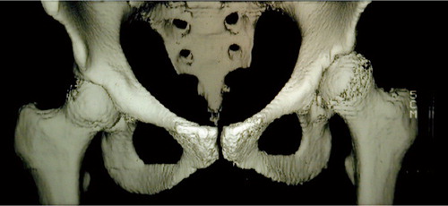 Figure 1. CT image of left dysplastic hip joint with global insufficient coverage of the femoral head and increased anteversion of the femoral neck.