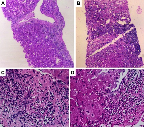 Figure 3 Histopathology of alcoholic hepatitis with added insult(s). (A) Extensive zone 3 porto-central necrosis with mixed inflammation in a patient with severe alcoholic hepatitis as per clinical history and biochemical features, but with added ayurvedic herbal medicine related injury (haematoxylin and eosin stain, H&E, 20×). (B) Severe focal lymphocytic aggregates seen in a patient with severe alcoholic hepatitis with reactivation of hepatitis B virus infection (H&E, 20×). (C) Lymphocytic and eosinophilic inflammation in a patient with alcoholic hepatitis with super added polyherbal medicine related drug-induced liver injury (H&E, 40×). (D) Lymphoplasmacytic interface hepatitis due to hepatitis C virus infection in the background of balloon-degeneration of hepatocytes in a patient with severe alcoholic hepatitis (H&E, 40×).
