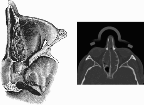 Figure 1. Left: Ethmoidal cells Citation[18] are often the source of the inflamed tissue. Right: The preoperative CT scan shows polyps in the right sinus sphenoidalis.