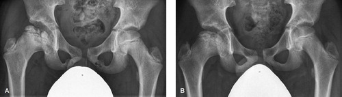 Figure 4. Bilateral VND in a 10-year-old female patient with right-sided Legg–Calvй–Perthes disease (A). Complete dissolution of the bilateral VND at 4-year follow-up (B).